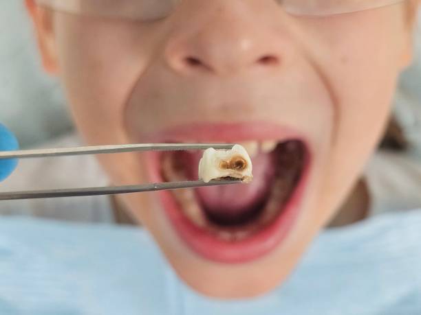 Best Emergency Dentist for Lost Fillings or Crowns in Toppenish, WA